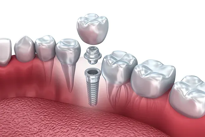 Illustration of a dental implant: the titanium post in the jaw, the abutment and the crown above it